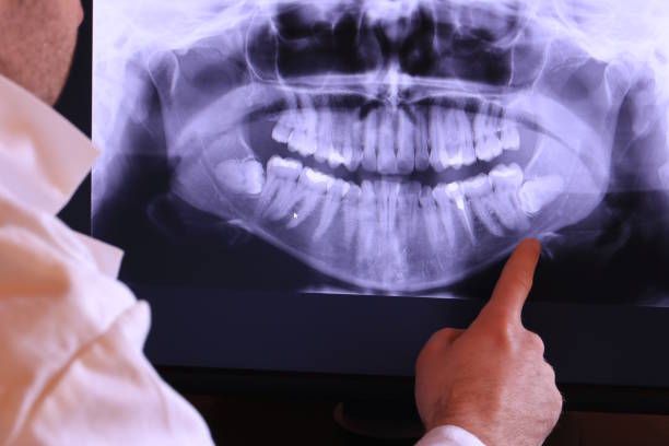 Best Emergency Wisdom Teeth Removal in Grantsville, UT